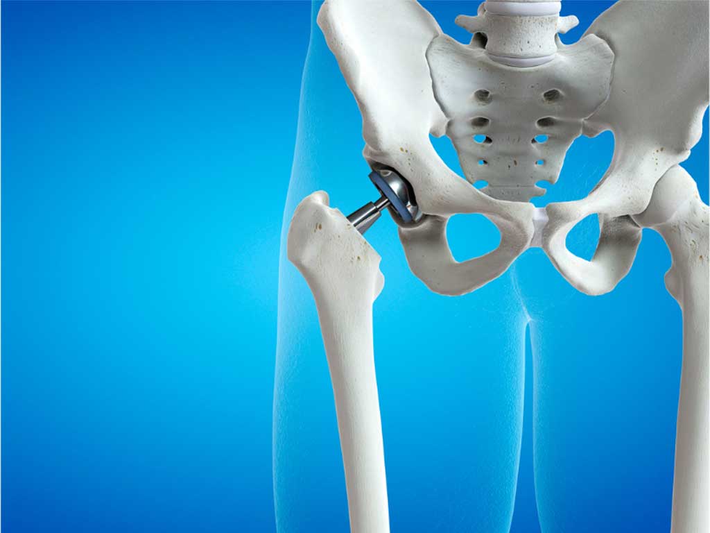 Joint Replacement Surgery in North Hollywood, Los Angeles & Echo Park - Urgent Orthopaedic Care